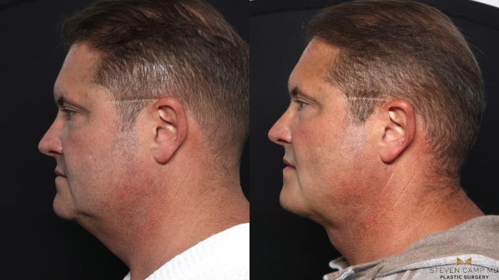 Before & After Necklift Case 670 Left Side View in Fort Worth & Arlington, Texas