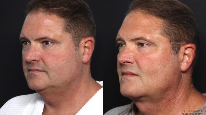 Before & After Necklift Case 670 Right Oblique View in Fort Worth & Arlington, Texas