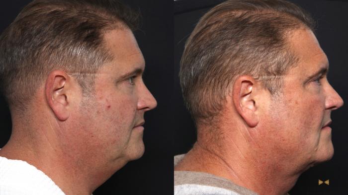 Before & After Necklift Case 670 Right Side View in Fort Worth & Arlington, Texas