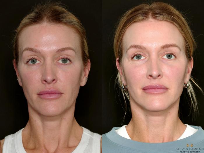 Before & After Necklift Case 717 Front View in Fort Worth & Arlington, Texas