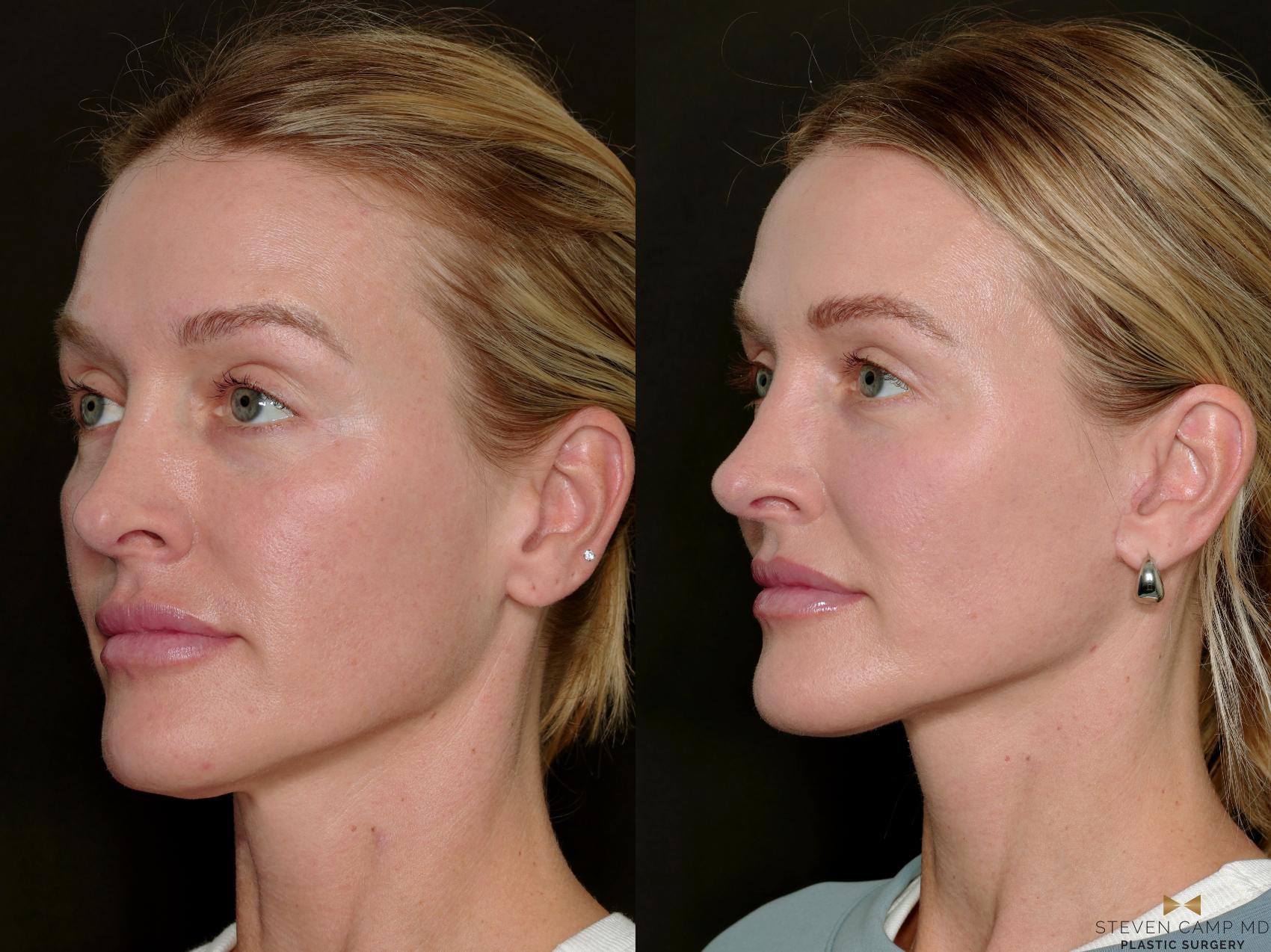 Before & After Necklift Case 717 Left Oblique View in Fort Worth & Arlington, Texas