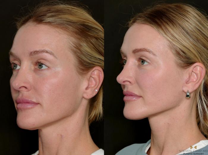 Before & After Necklift Case 717 Left Oblique View in Fort Worth & Arlington, Texas
