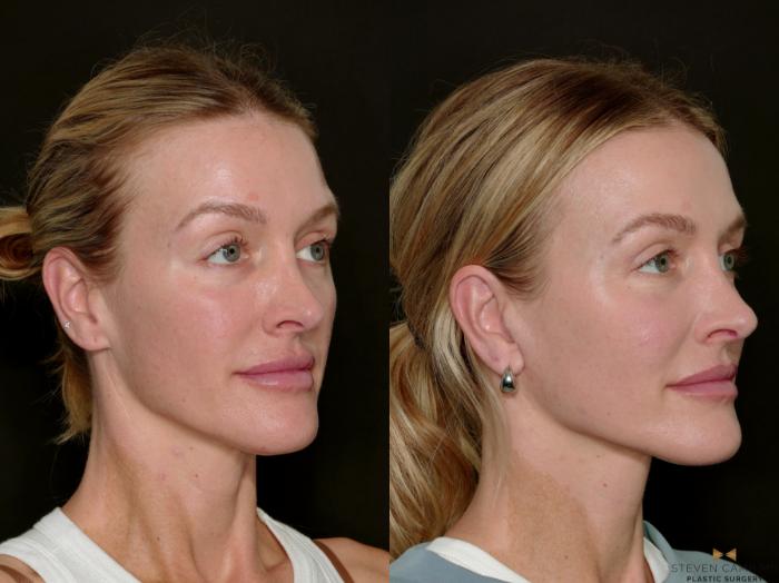 Before & After Necklift Case 717 Right Oblique View in Fort Worth & Arlington, Texas