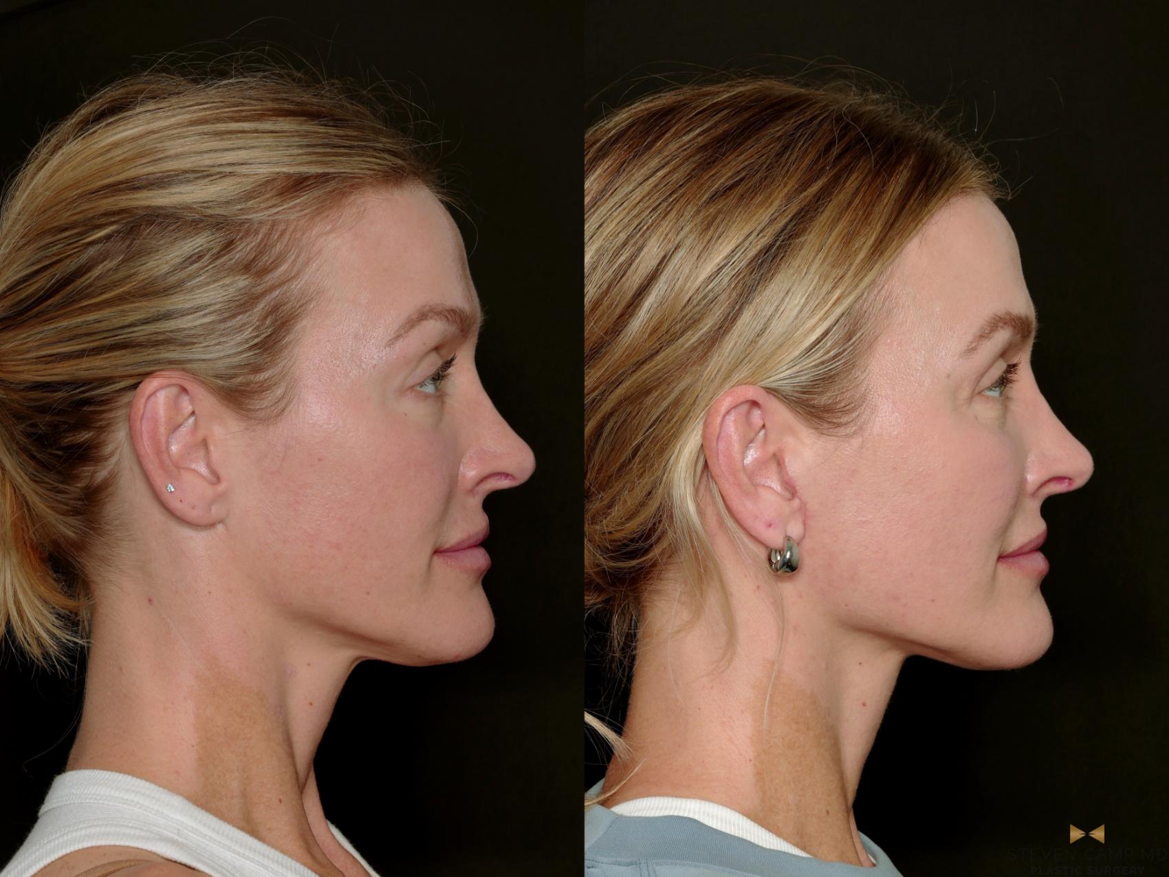 Before & After Necklift Case 717 Right Side View in Fort Worth & Arlington, Texas