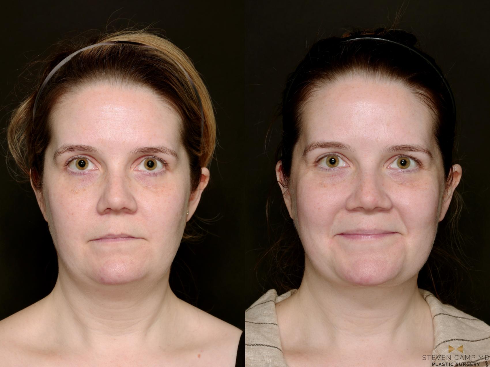 Before & After Necklift Case 719 Front View in Fort Worth & Arlington, Texas