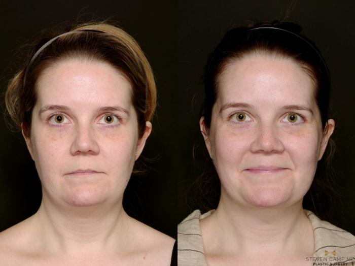 Before & After Necklift Case 719 Front View in Fort Worth & Arlington, Texas
