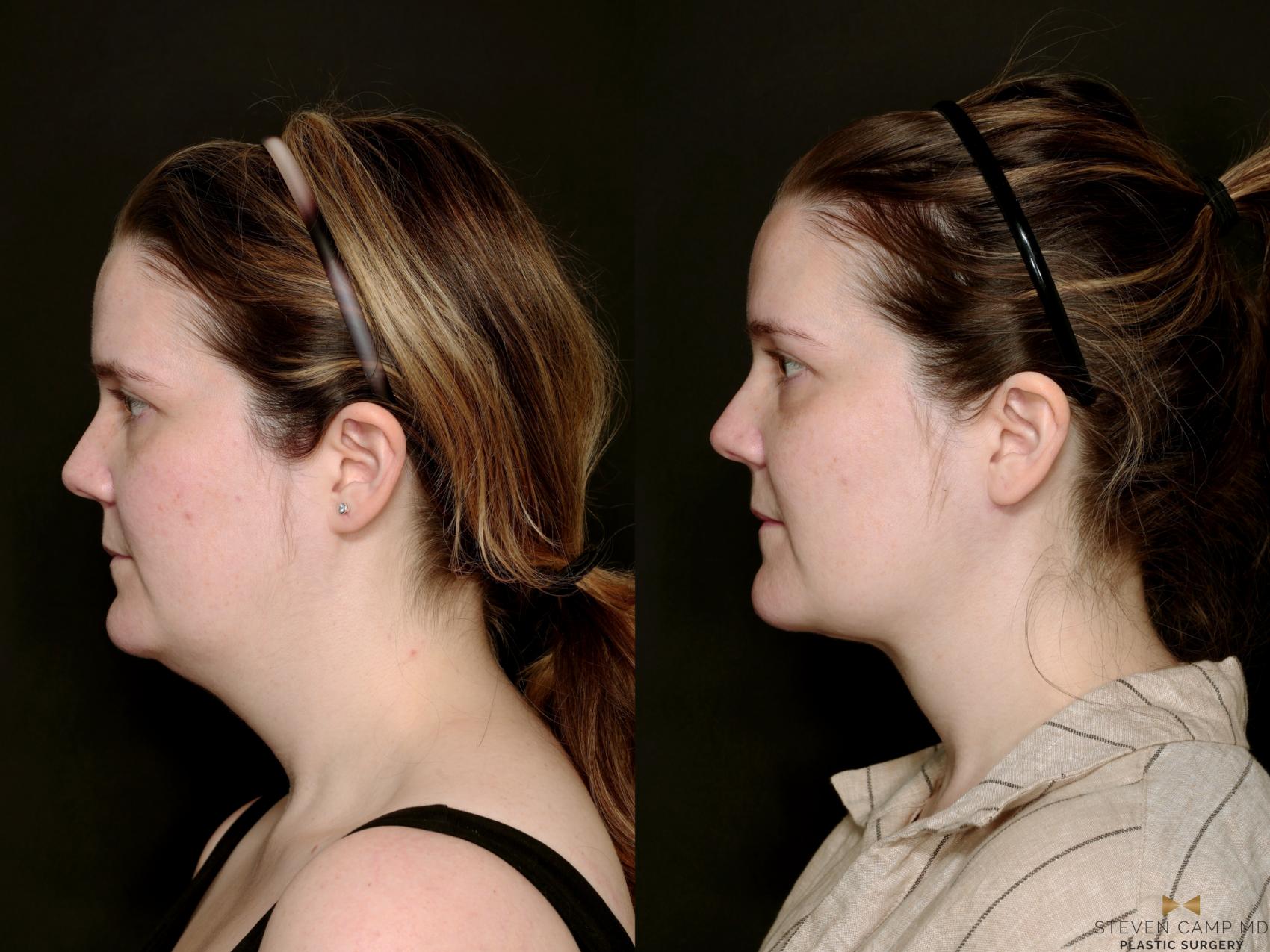 Before & After Necklift Case 719 Left Side View in Fort Worth & Arlington, Texas