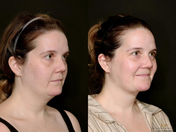 Before & After Necklift Case 719 Right Oblique View in Fort Worth & Arlington, Texas