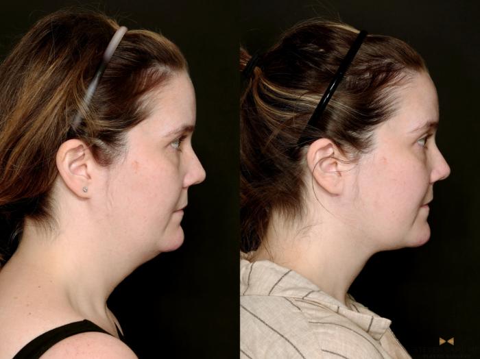 Before & After Necklift Case 719 Right Side View in Fort Worth & Arlington, Texas