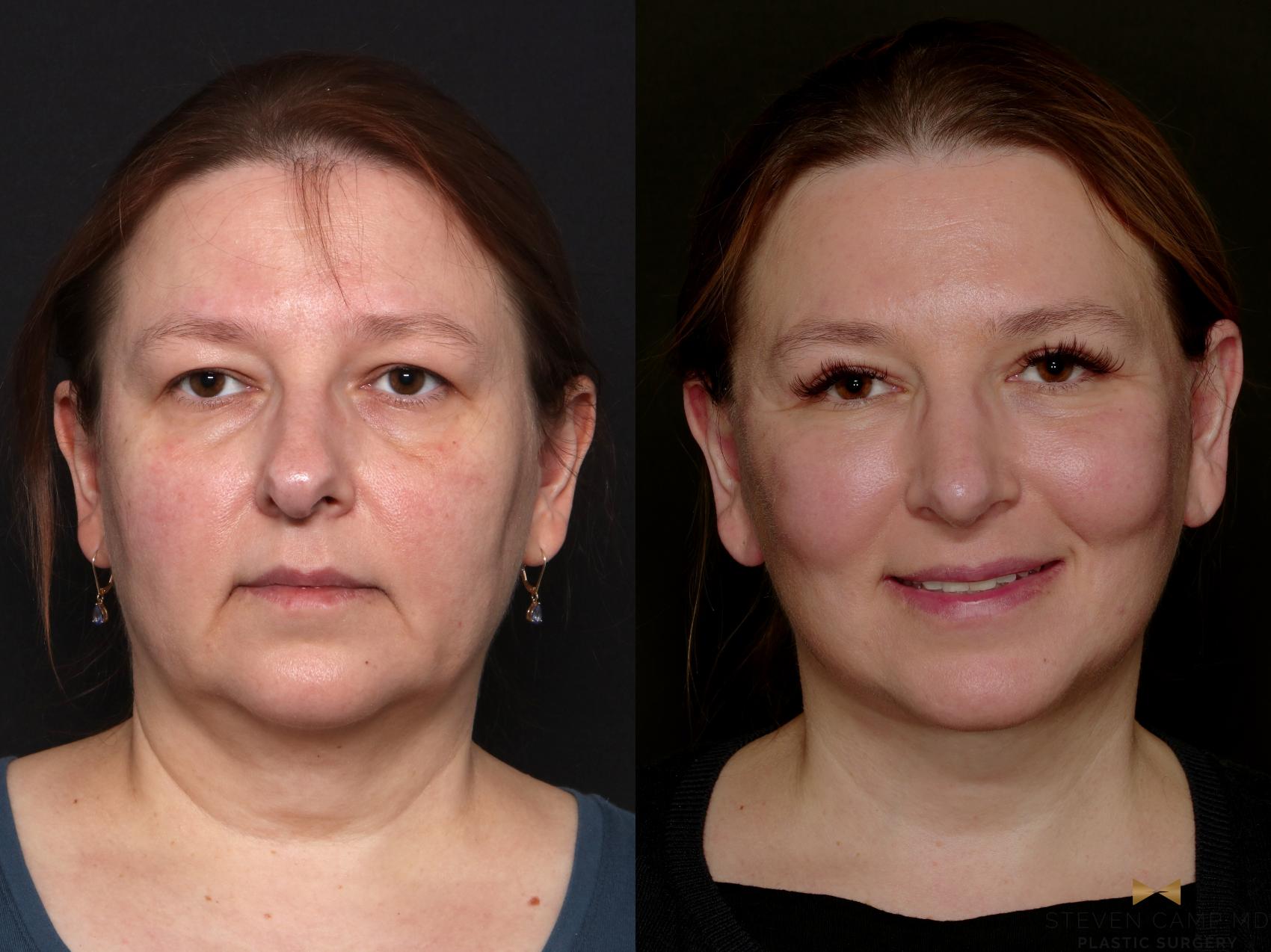 Before & After Necklift Case 763 Front View in Fort Worth & Arlington, Texas