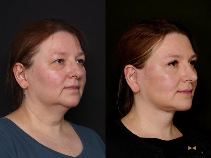 Before & After Necklift Case 763 Right Oblique View in Fort Worth & Arlington, Texas