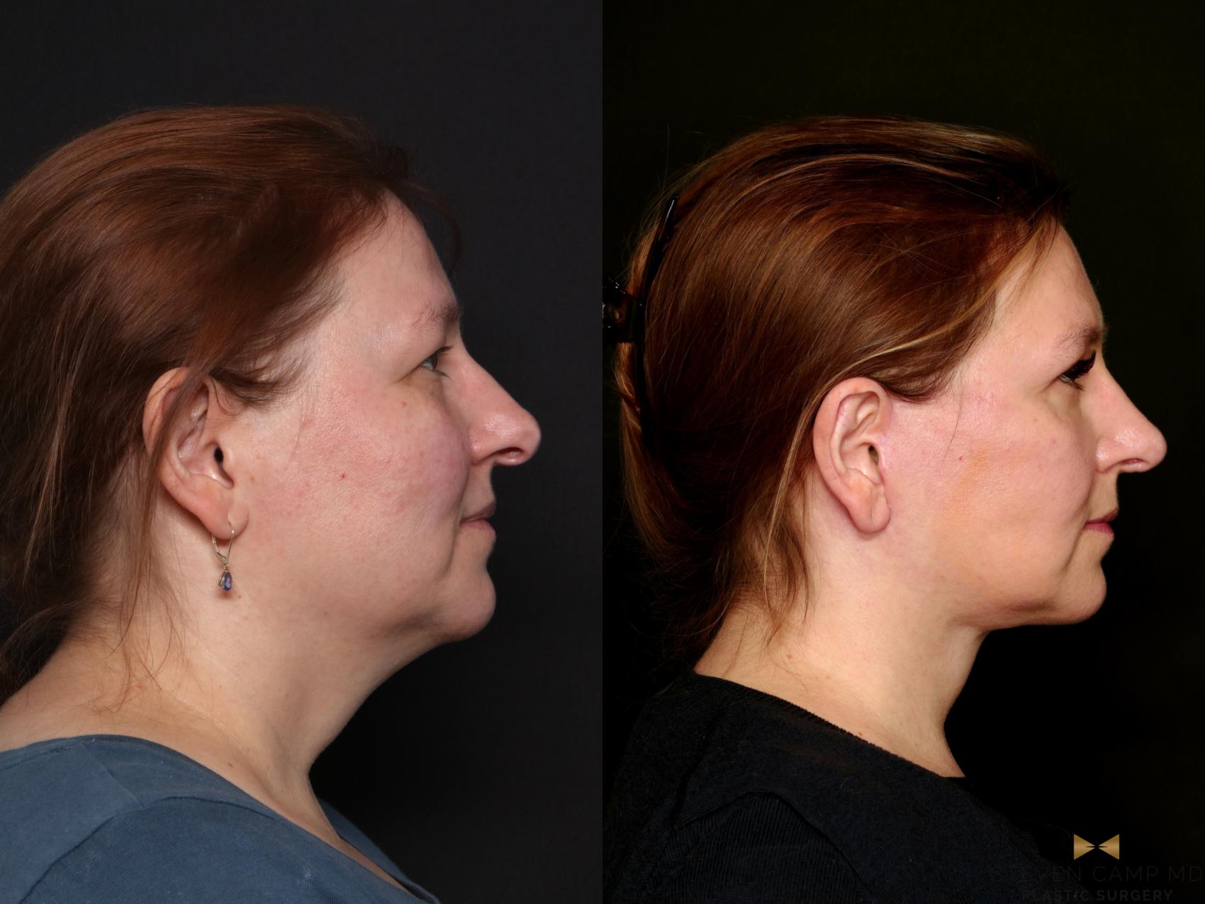 Before & After Necklift Case 763 Right Side View in Fort Worth & Arlington, Texas
