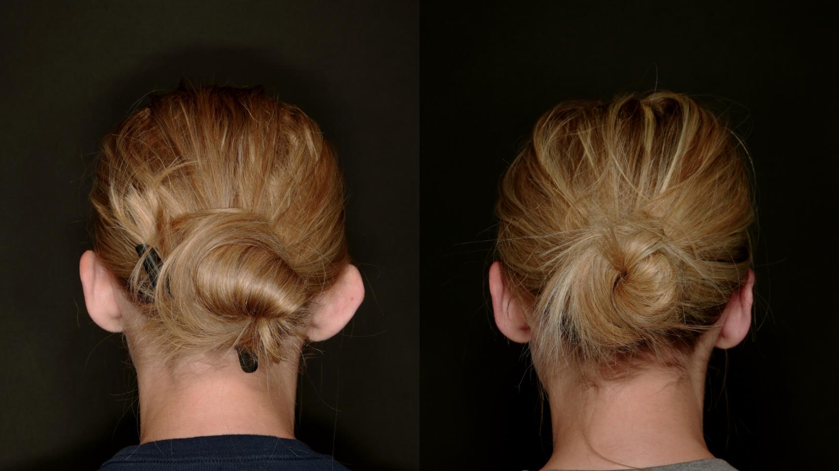 Before & After Otoplasty (Ear surgery) Case 773 Back View in Fort Worth & Arlington, Texas