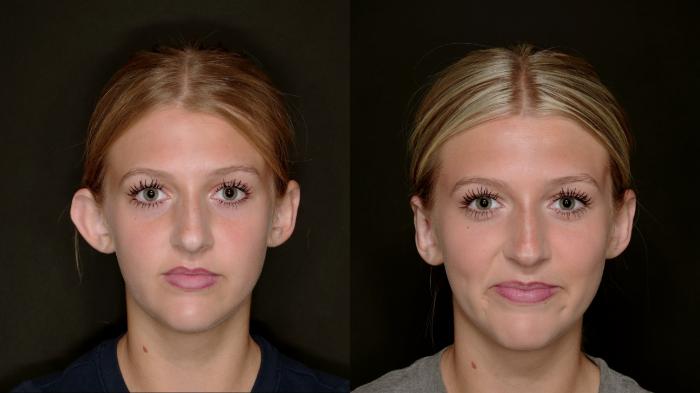 Before & After Otoplasty (Ear surgery) Case 773 Front View in Fort Worth & Arlington, Texas