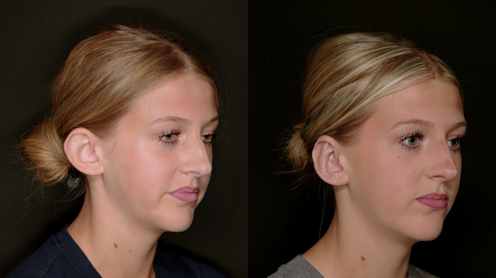 Before & After Otoplasty (Ear surgery) Case 773 Right Oblique View in Fort Worth & Arlington, Texas