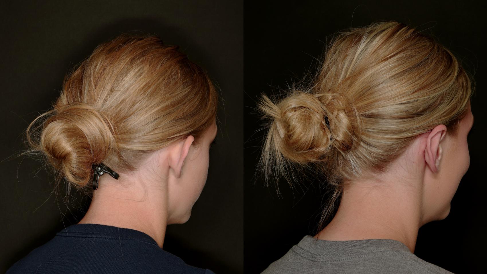 Before & After Otoplasty (Ear surgery) Case 773 Right Posterior Oblique View in Fort Worth & Arlington, Texas