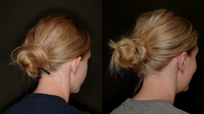 Before & After Otoplasty (Ear surgery) Case 773 Right Posterior Oblique View in Fort Worth & Arlington, Texas