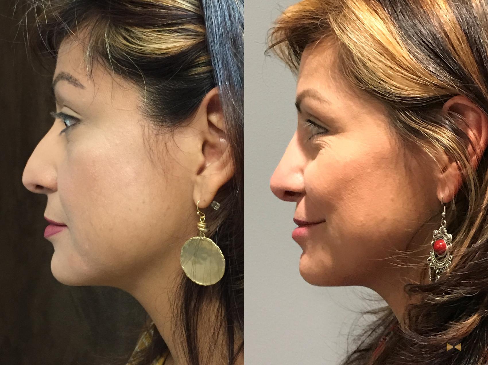 Before & After Rhinoplasty Case 138 View #1 View in Fort Worth, Texas