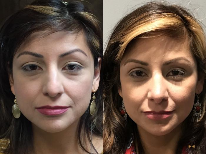 Before & After Rhinoplasty Case 138 View #2 View in Fort Worth & Arlington, Texas