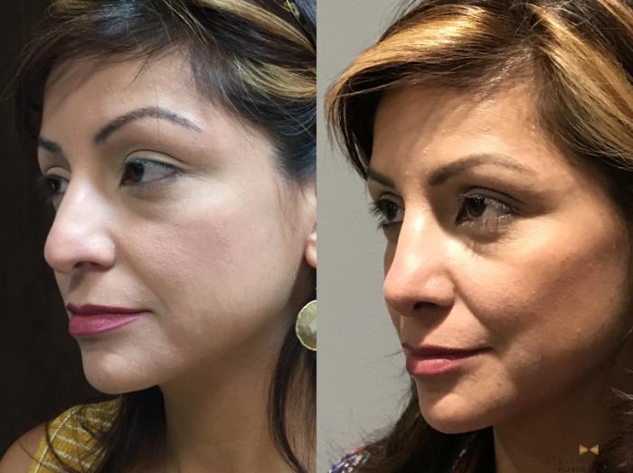 Before & After Rhinoplasty Case 138 View #3 View in Fort Worth & Arlington, Texas