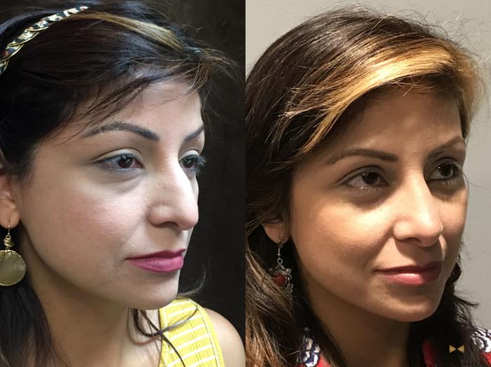 Before & After Rhinoplasty Case 138 View #4 View in Fort Worth & Arlington, Texas