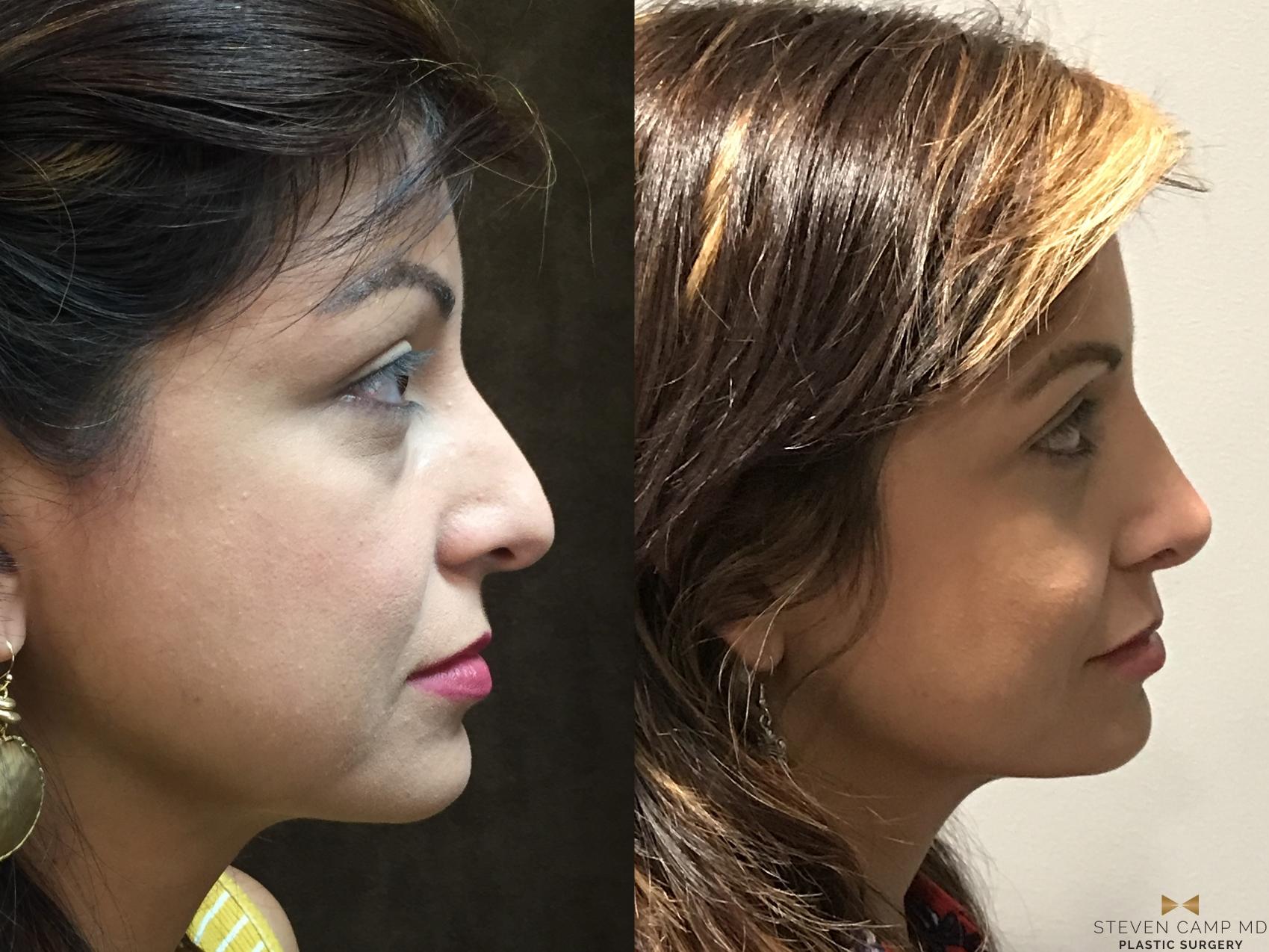 Before & After Rhinoplasty Case 138 View #5 View in Fort Worth & Arlington, Texas