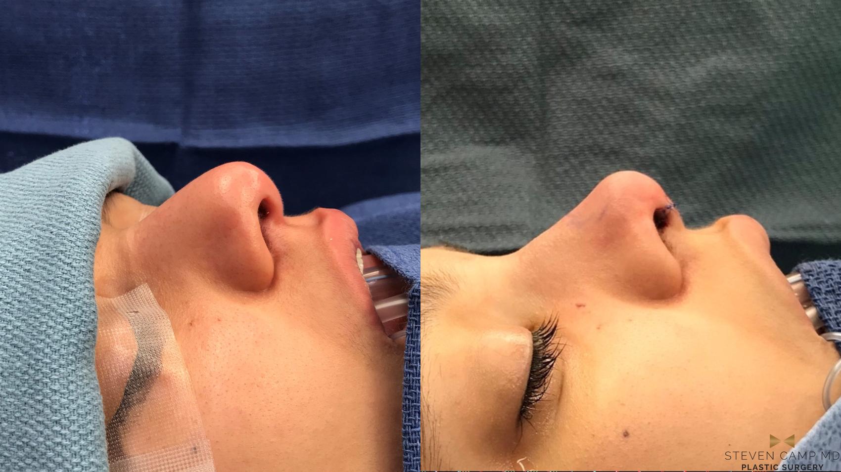 Before & After Rhinoplasty Case 146 View #1 View in Fort Worth, Texas