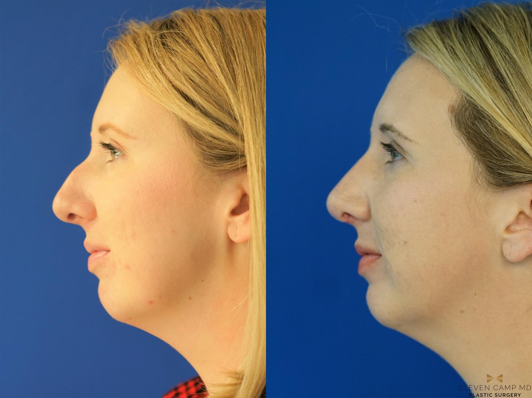 Before & After Rhinoplasty Case 162 View #1 View in Fort Worth & Arlington, Texas