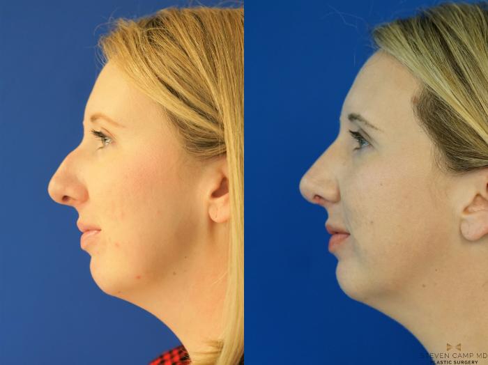 Before & After Rhinoplasty Case 162 View #1 View in Fort Worth & Arlington, Texas