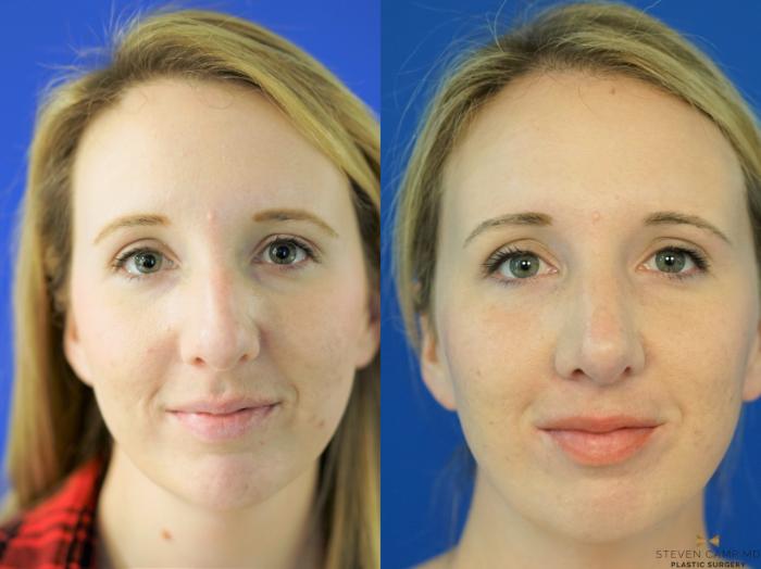Before & After Rhinoplasty Case 162 View #2 View in Fort Worth & Arlington, Texas