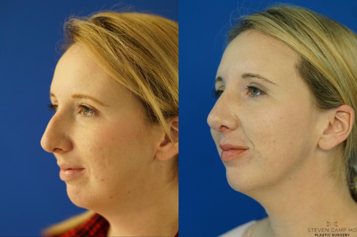 Before & After Rhinoplasty Case 162 View #3 View in Fort Worth & Arlington, Texas