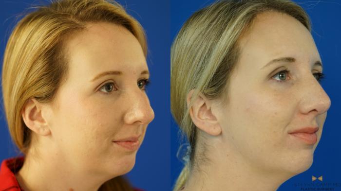 Before & After Rhinoplasty Case 162 View #4 View in Fort Worth & Arlington, Texas