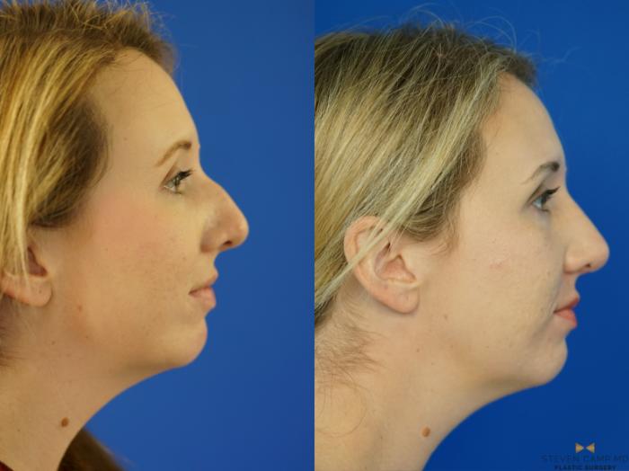 Before & After Rhinoplasty Case 162 View #5 View in Fort Worth & Arlington, Texas