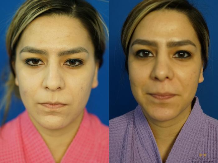 Before & After Rhinoplasty Case 333 Front View in Fort Worth, Texas