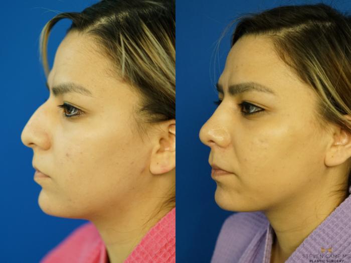 Before & After Rhinoplasty Case 333 Left Oblique View in Fort Worth, Texas
