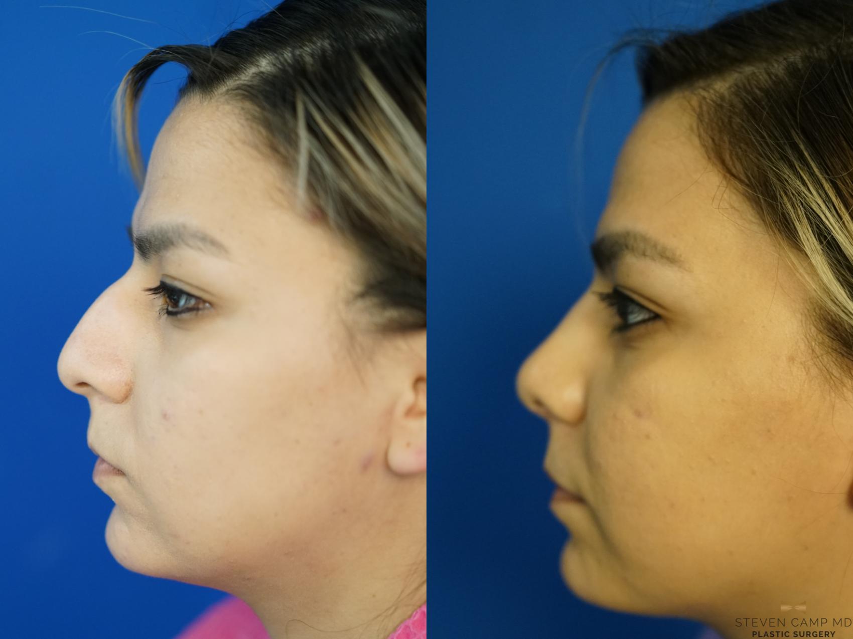 Before & After Rhinoplasty Case 333 Left Side View in Fort Worth, Texas