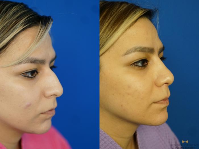Before & After Rhinoplasty Case 333 Right Oblique View in Fort Worth, Texas