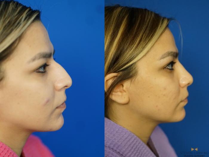 Before & After Rhinoplasty Case 333 Right Side View in Fort Worth, Texas