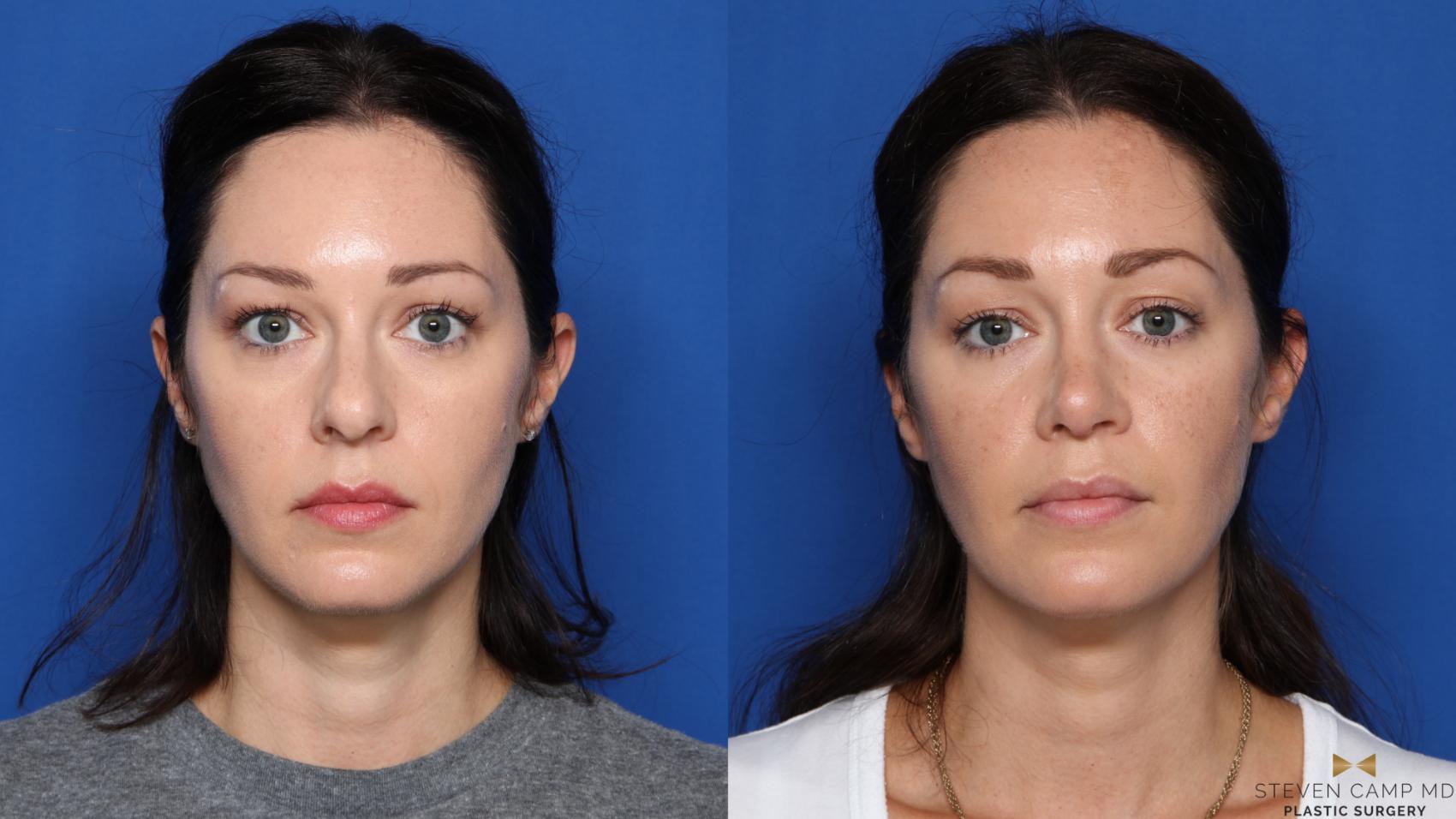 Before & After Rhinoplasty Case 420 Front View in Fort Worth, Texas