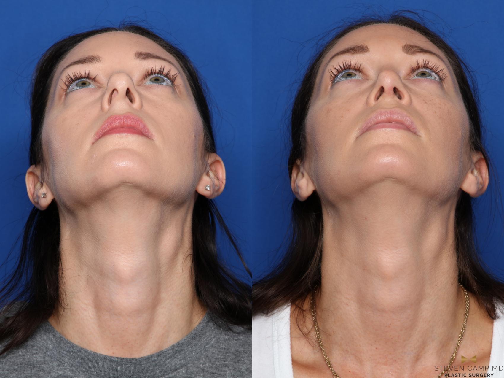 Before & After Rhinoplasty Case 420 Inferior View View in Fort Worth, Texas
