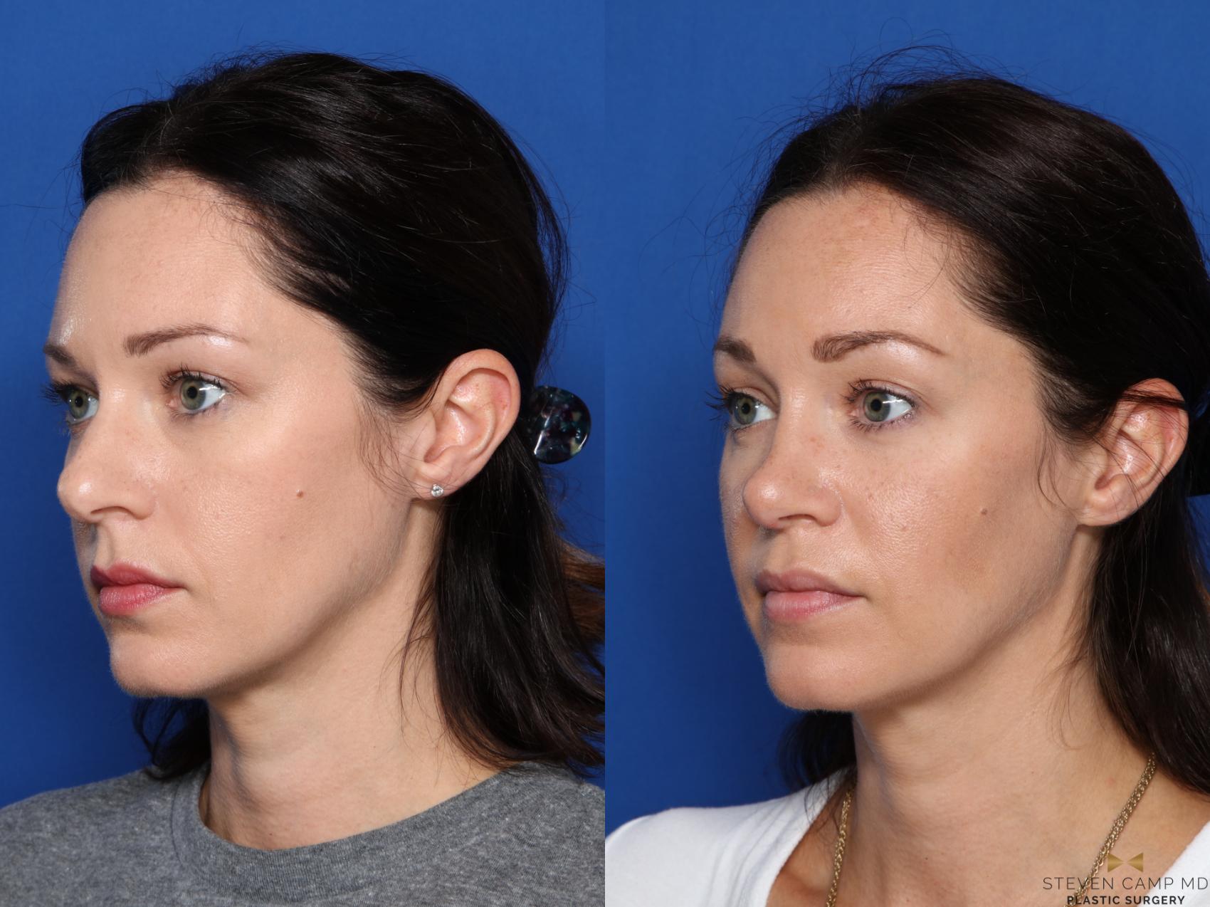 Before & After Rhinoplasty Case 420 Left Oblique View in Fort Worth, Texas