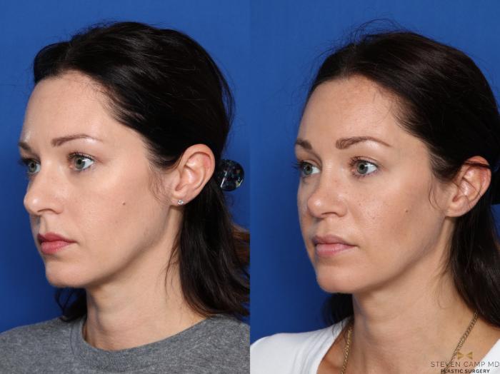 Before & After Rhinoplasty Case 420 Left Oblique View in Fort Worth & Arlington, Texas