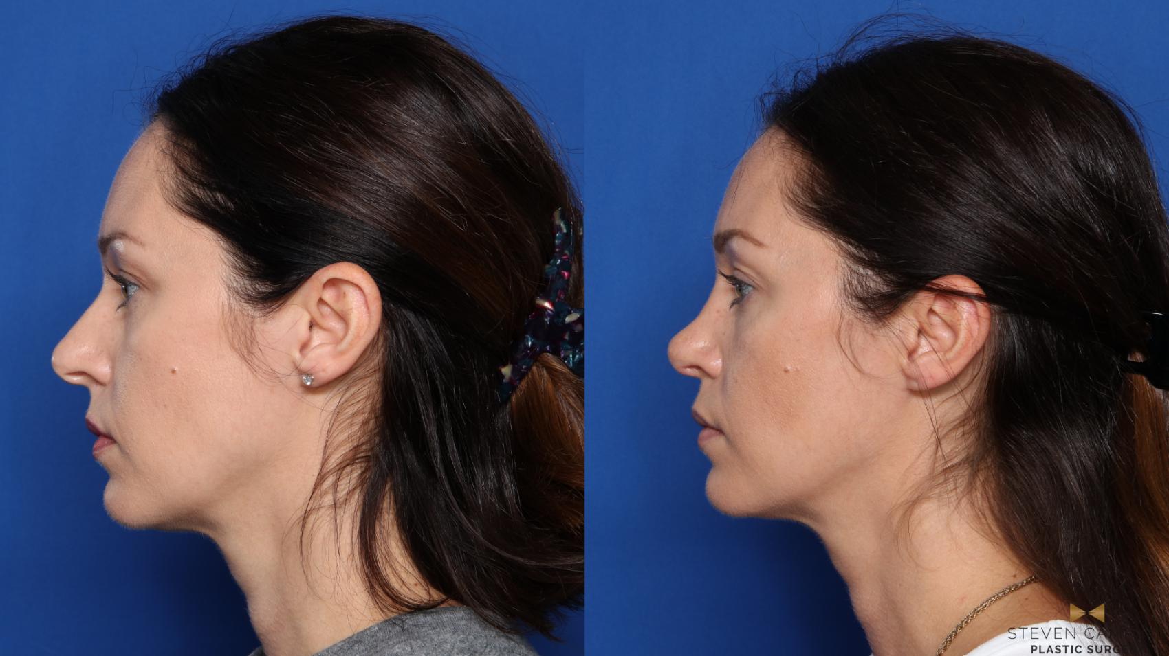 Before & After Rhinoplasty Case 420 Left Side View in Fort Worth, Texas
