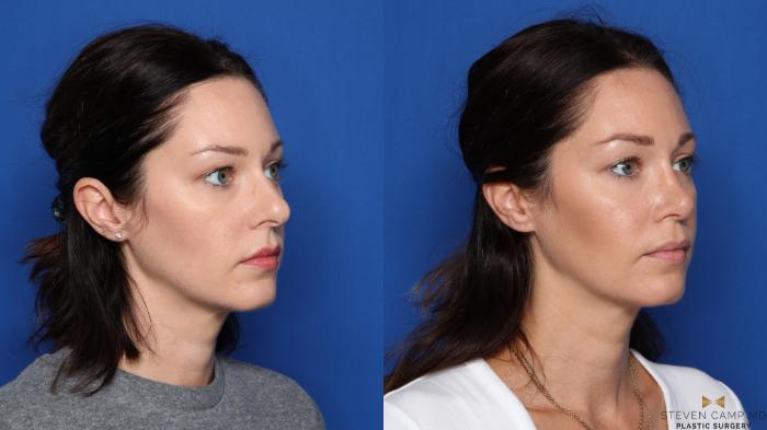Before & After Rhinoplasty Case 420 Right Oblique View in Fort Worth & Arlington, Texas