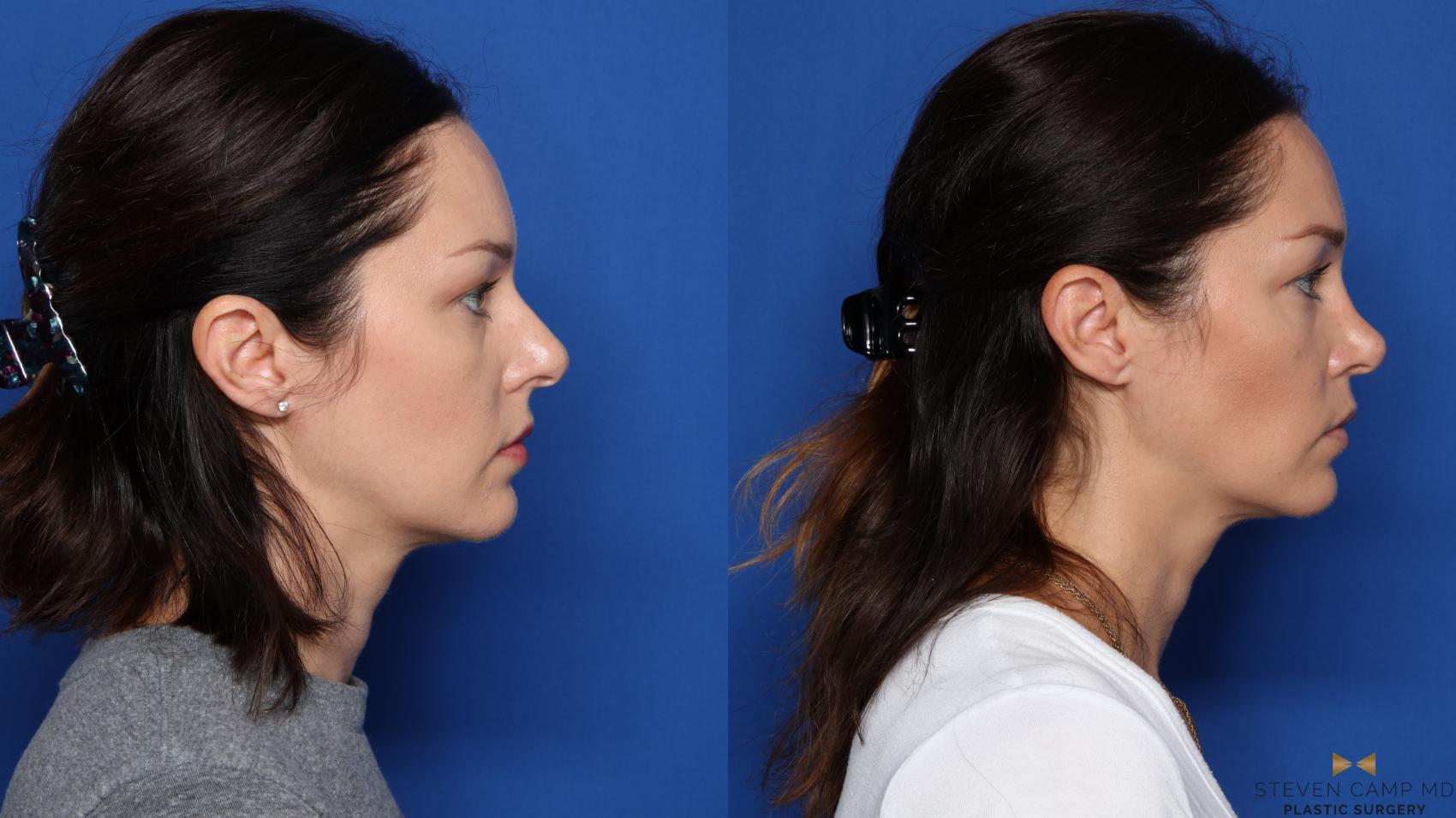 Before & After Rhinoplasty Case 420 Right Side View in Fort Worth, Texas