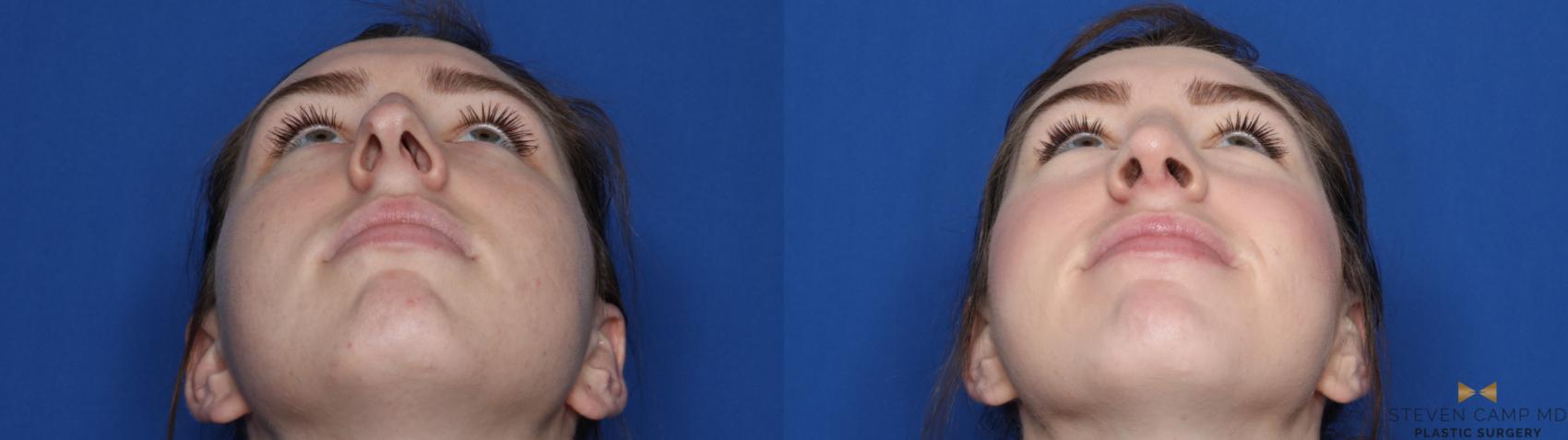 Before & After Rhinoplasty Case 427 Front View in Fort Worth & Arlington, Texas