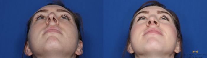 Before & After Rhinoplasty Case 427 Front View in Fort Worth & Arlington, Texas