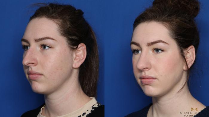 Before & After Rhinoplasty Case 427 Left Oblique View in Fort Worth & Arlington, Texas
