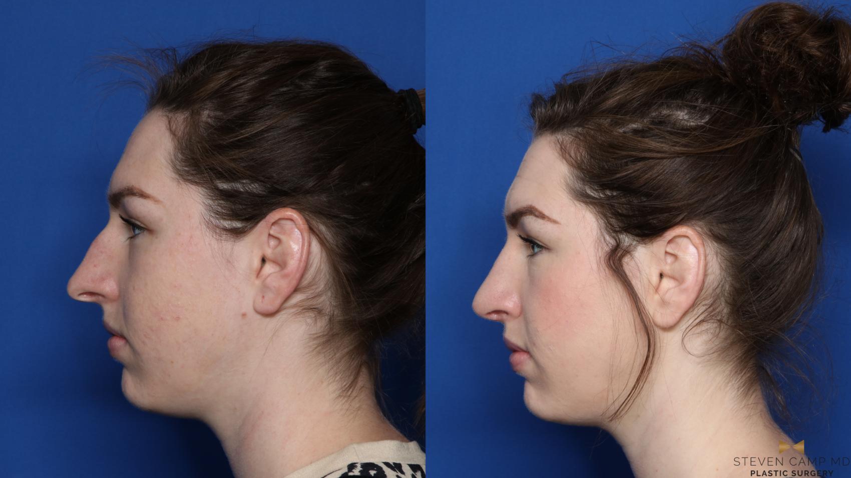 Before & After Rhinoplasty Case 427 Left Side View in Fort Worth, Texas