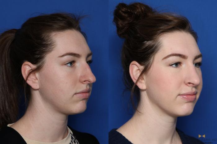 Before & After Rhinoplasty Case 427 Right Oblique View in Fort Worth & Arlington, Texas